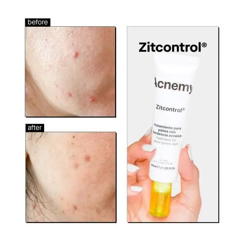 Zitcontrol Treatment Cream - Image 3