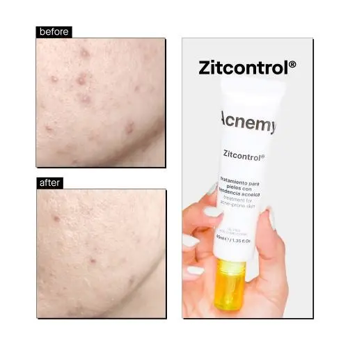 Zitcontrol Treatment Cream - Image 4